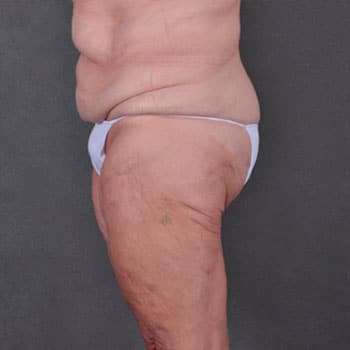 massive weight loss - patient 7939 - before 2 massive weight loss - patient 7939 - before 2