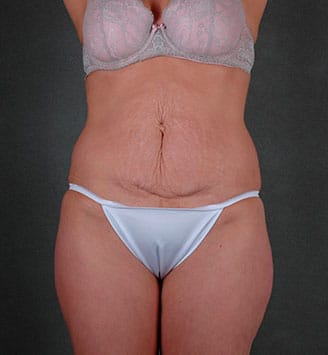 mommy makeover - patient 7839 - before 1 mommy makeover - patient 7839 - before 1