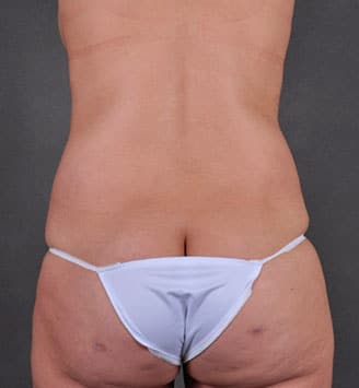 liposuction - patient 7860 - after 3 liposuction - patient 7860 - after 3