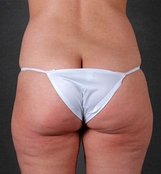 liposuction - patient 7860 - before 3 liposuction - patient 7860 - before 3
