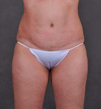 liposuction - patient 7860 - after 1 liposuction - patient 7860 - after 1