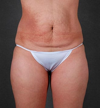 liposuction - patient 7860 - before 1 liposuction - patient 7860 - before 1