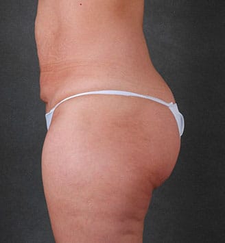 liposuction - patient 7860 - before 2 liposuction - patient 7860 - before 2