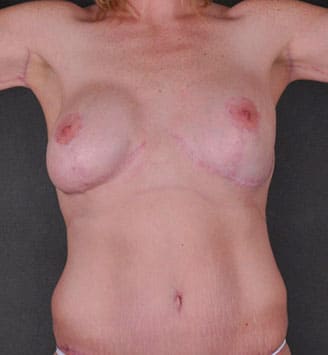 tummy tuck - patient 7888 - after 1 tummy tuck - patient 7888 - after 1