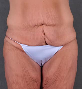 tummy tuck - patient 7888 - before 3 tummy tuck - patient 7888 - before 3