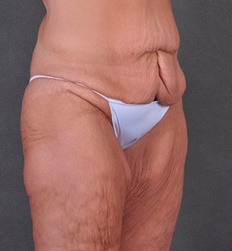 tummy tuck - patient 7888 - before 2 tummy tuck - patient 7888 - before 2