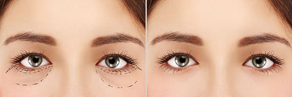 Blepharoplasty Recovery Time?