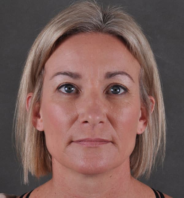 liposuction - patient 8901 - after 6 liposuction - patient 8901 - after 6