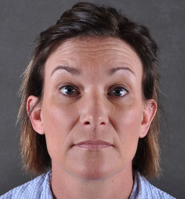 liposuction - patient 8901 - before 6 liposuction - patient 8901 - before 6