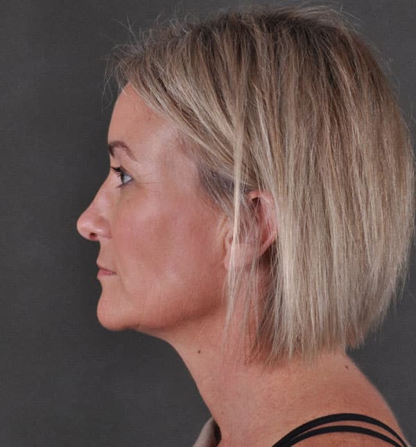 liposuction - patient 8901 - after 9 liposuction - patient 8901 - after 9