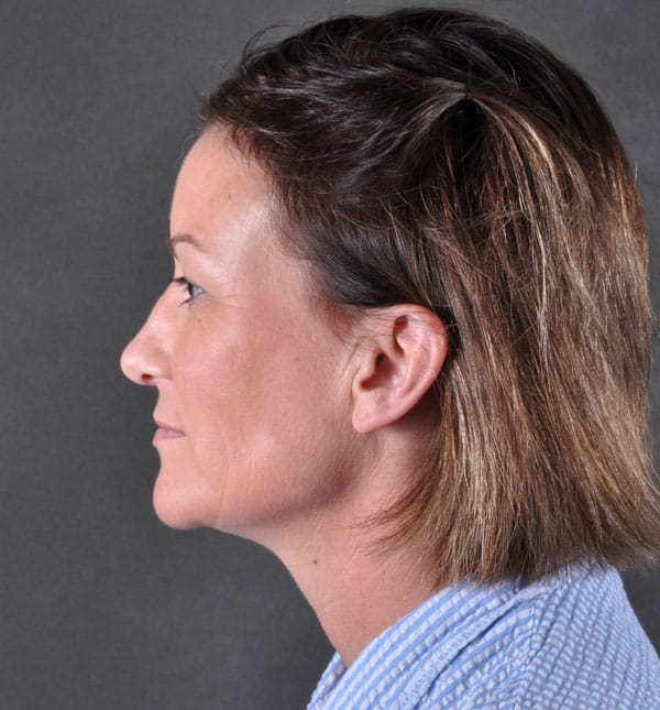 liposuction - patient 8901 - before 9 liposuction - patient 8901 - before 9