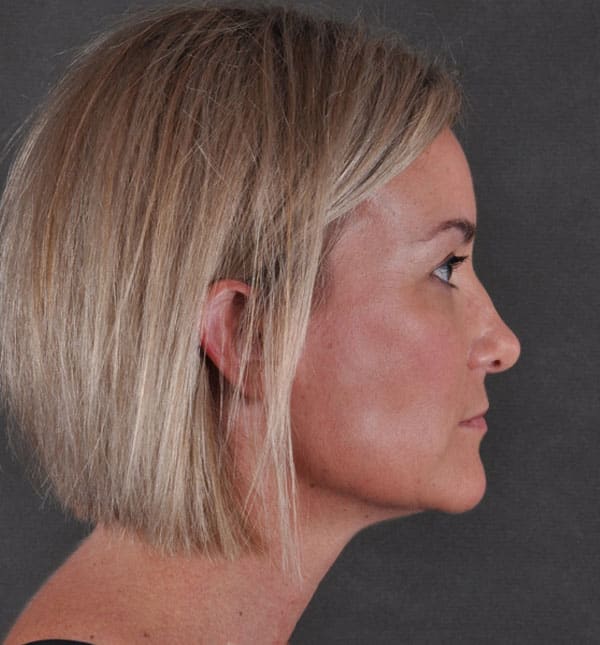 liposuction - patient 8901 - after 7 liposuction - patient 8901 - after 7