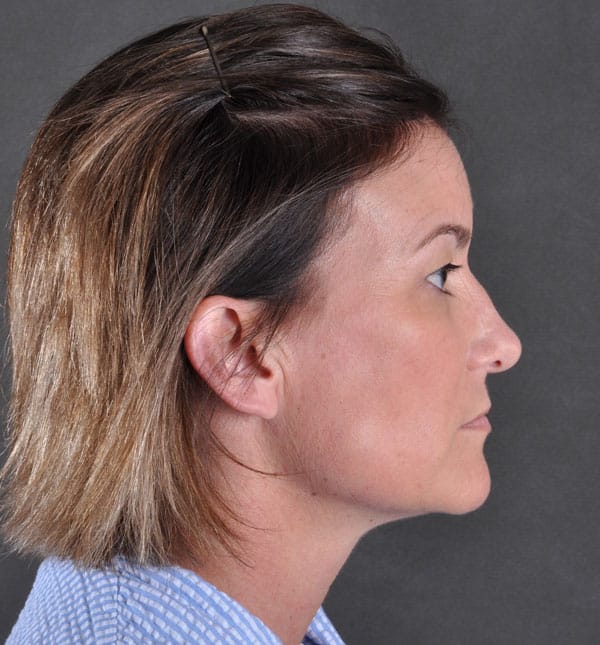 liposuction - patient 8901 - before 7 liposuction - patient 8901 - before 7