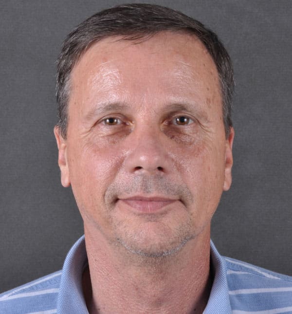 blepharoplasty - patient 8806 - before 1 blepharoplasty - patient 8806 - before 1