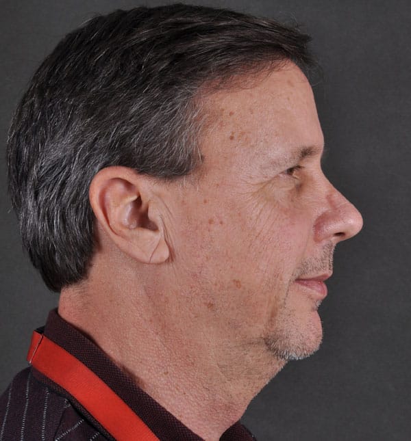 blepharoplasty - patient 8806 - after 3 blepharoplasty - patient 8806 - after 3