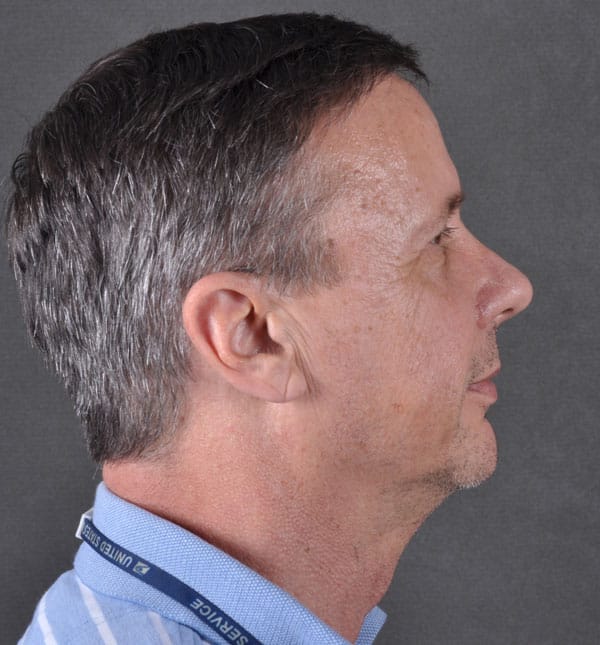 blepharoplasty - patient 8806 - before 3 blepharoplasty - patient 8806 - before 3