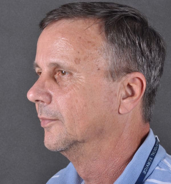 blepharoplasty - patient 8806 - before 2 blepharoplasty - patient 8806 - before 2