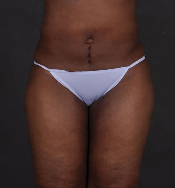 brazilian butt lift - patient 9194 - after 1 brazilian butt lift - patient 9194 - after 1