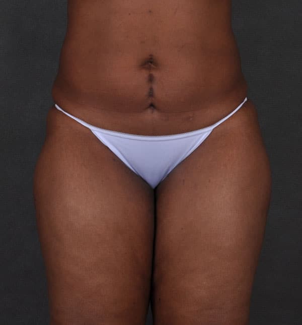 brazilian butt lift - patient 9194 - before 1 brazilian butt lift - patient 9194 - before 1