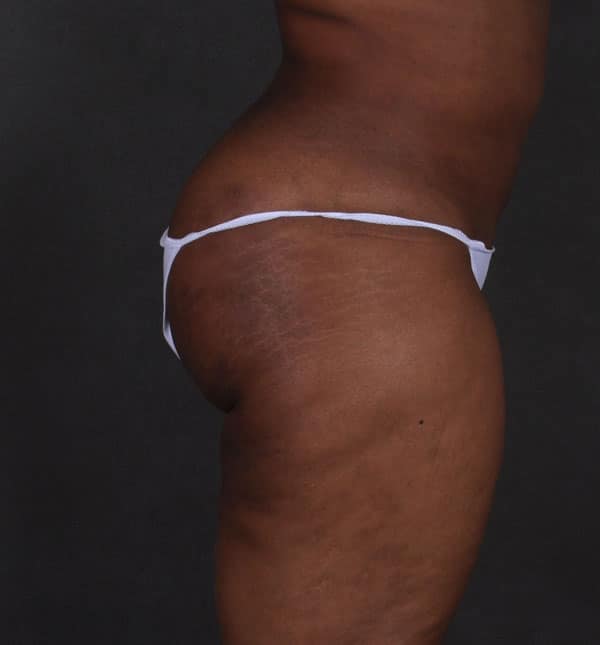 brazilian butt lift - patient 9194 - after 3 brazilian butt lift - patient 9194 - after 3