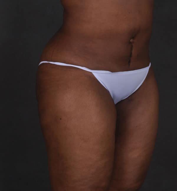 brazilian butt lift - patient 9194 - after 2 brazilian butt lift - patient 9194 - after 2