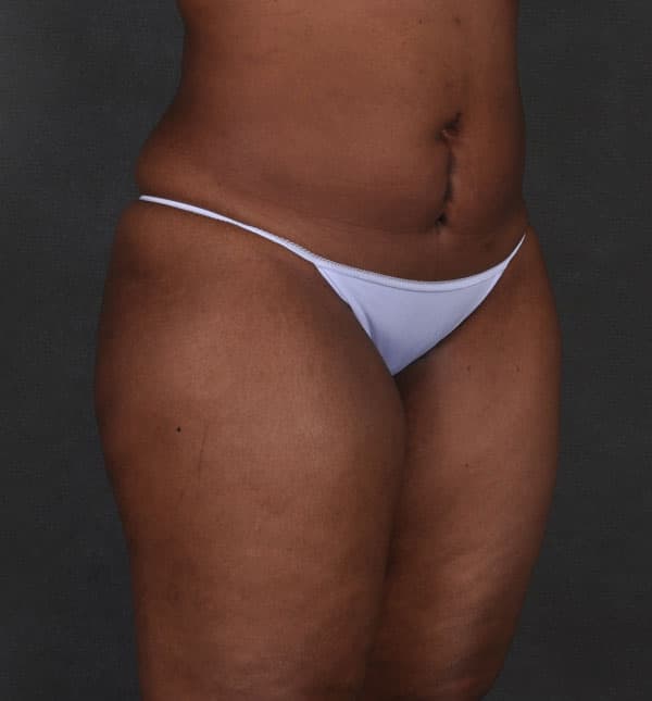 brazilian butt lift - patient 9194 - before 2 brazilian butt lift - patient 9194 - before 2