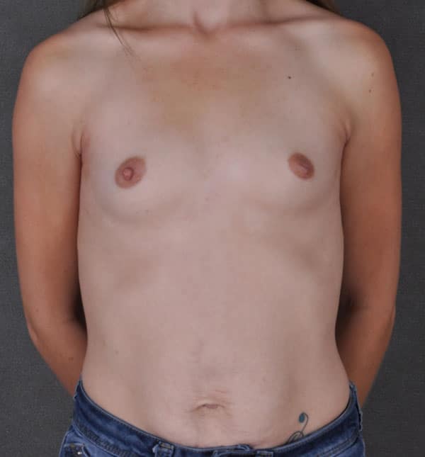 breast augmentation - patient 8868 - before 1 breast augmentation - patient 8868 - before 1