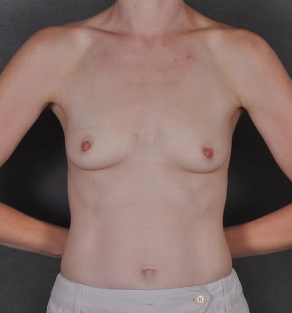 breast augmentation - patient 8951 - before 1 breast augmentation - patient 8951 - before 1