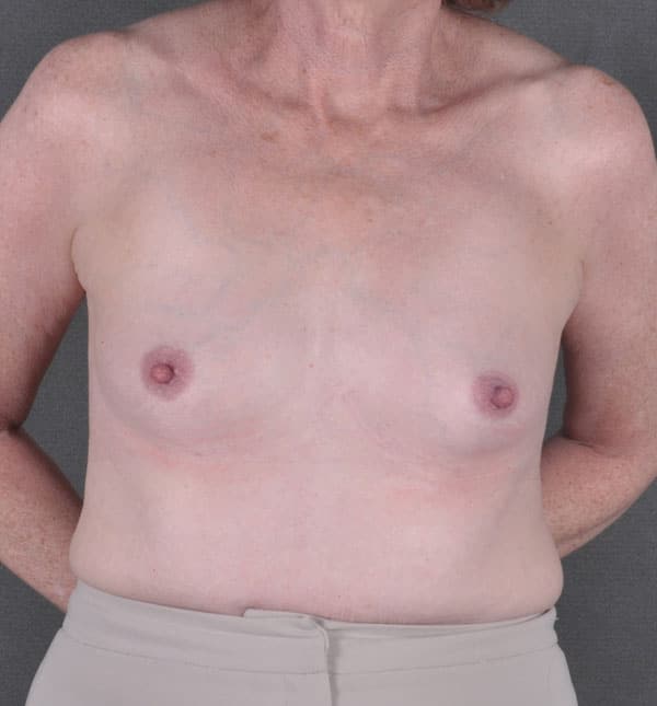 breast augmentation - patient 8958 - before 1 breast augmentation - patient 8958 - before 1