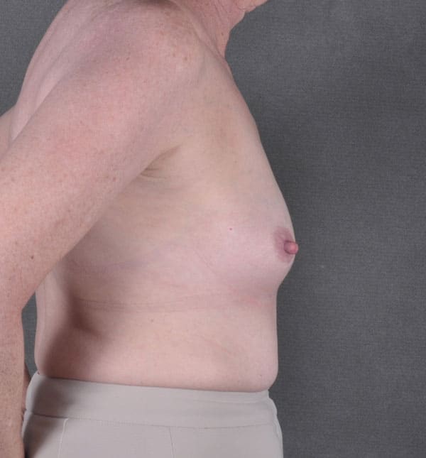 breast augmentation - patient 8958 - before 3 breast augmentation - patient 8958 - before 3