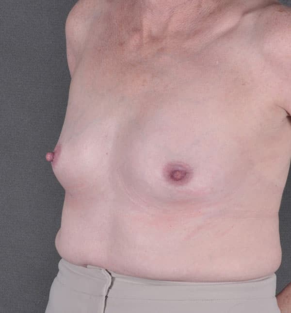 breast augmentation - patient 8958 - before 4 breast augmentation - patient 8958 - before 4