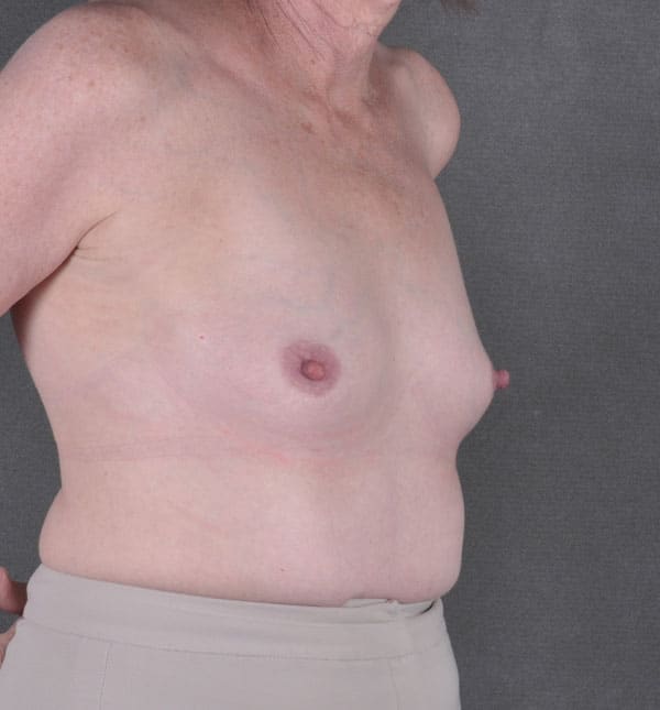 breast augmentation - patient 8958 - before 2 breast augmentation - patient 8958 - before 2