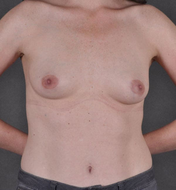 breast augmentation - patient 9073 - before 1 breast augmentation - patient 9073 - before 1