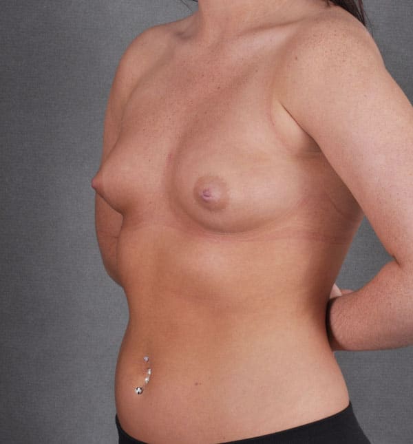 breast augmentation - patient 9107 - before 4 breast augmentation - patient 9107 - before 4