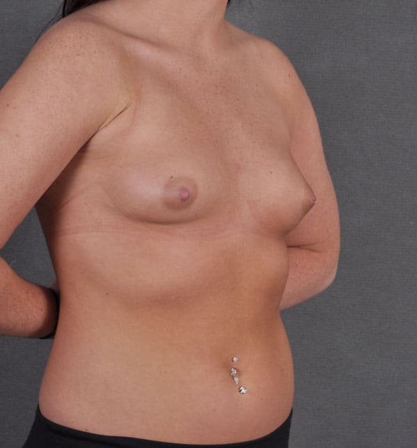 breast augmentation - patient 9107 - before 2 breast augmentation - patient 9107 - before 2