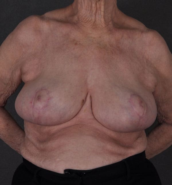 breast reduction - patient 8913 - after 1 breast reduction - patient 8913 - after 1