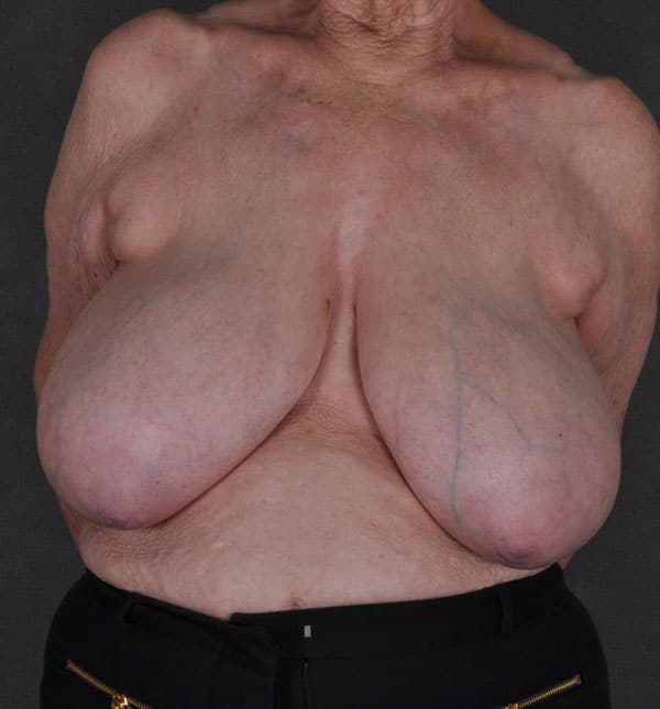breast reduction - patient 8913 - before 1 breast reduction - patient 8913 - before 1