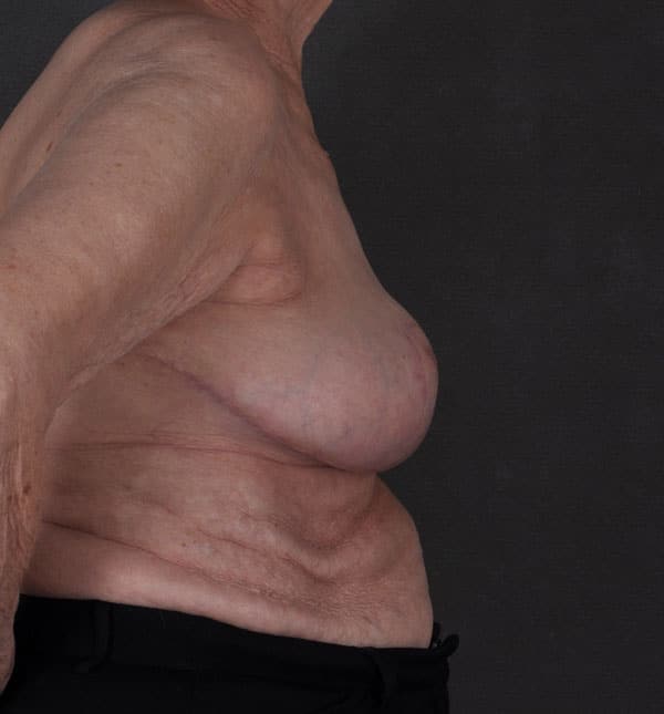 breast reduction - patient 8913 - after 2 breast reduction - patient 8913 - after 2