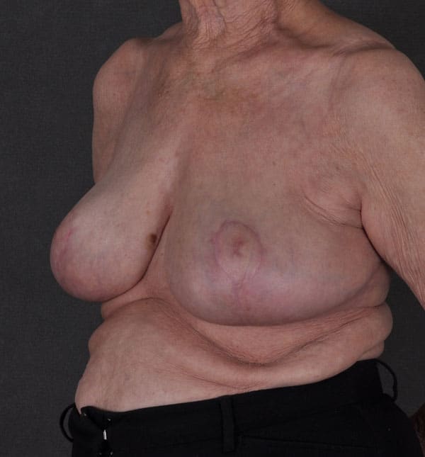 breast reduction - patient 8913 - after 3 breast reduction - patient 8913 - after 3