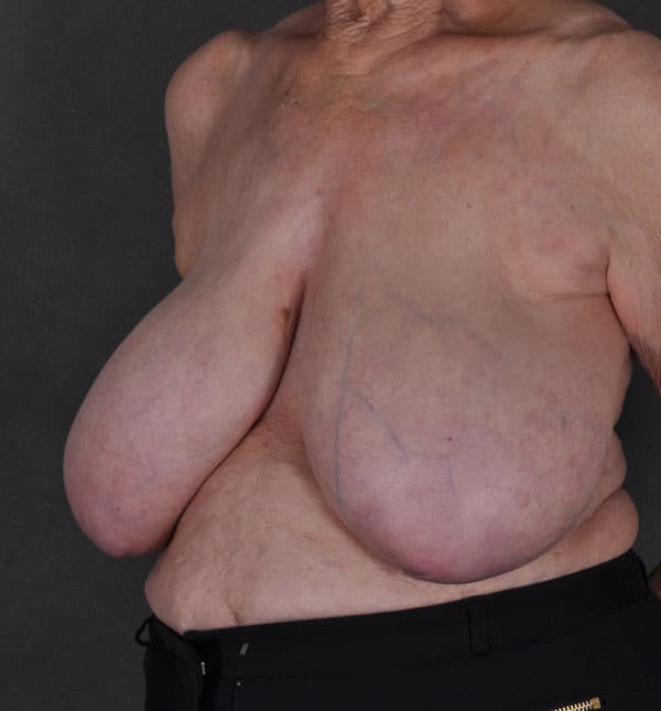 breast reduction - patient 8913 - before 3 breast reduction - patient 8913 - before 3