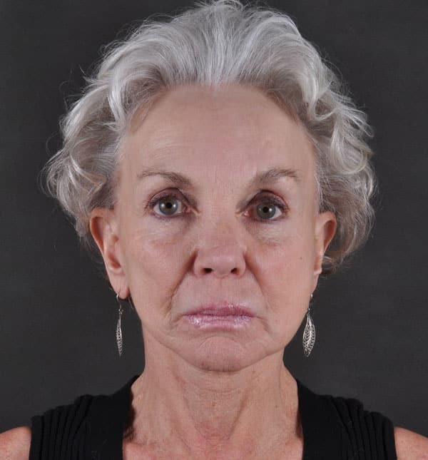facelift - patient 8684 - after 1 facelift - patient 8684 - after 1