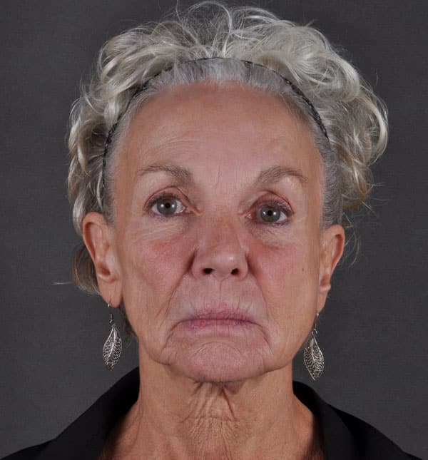 facelift - patient 8684 - before 1 facelift - patient 8684 - before 1