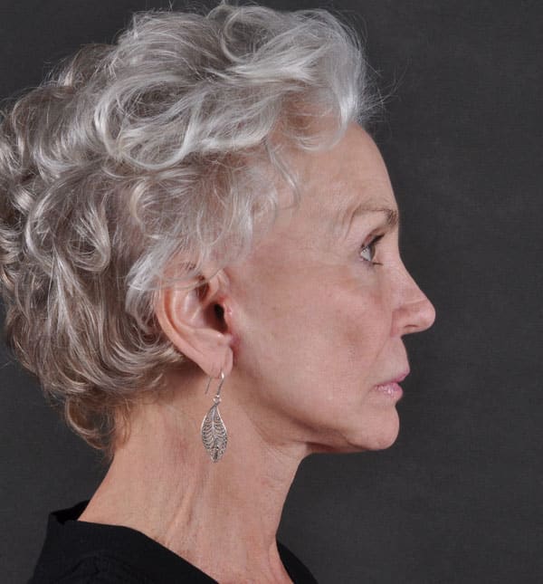 facelift - patient 8684 - after 3 facelift - patient 8684 - after 3