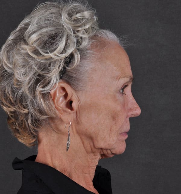 facelift - patient 8684 - before 3 facelift - patient 8684 - before 3