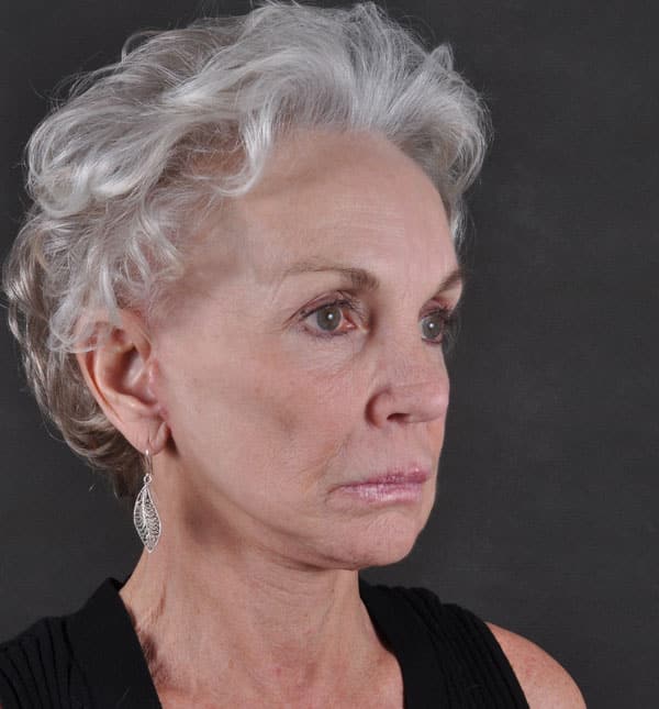 facelift - patient 8684 - after 2 facelift - patient 8684 - after 2