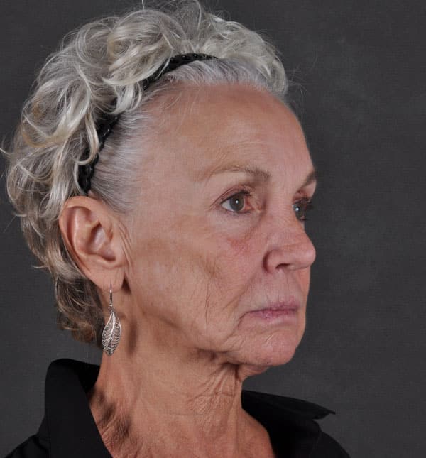 facelift - patient 8684 - before 2 facelift - patient 8684 - before 2
