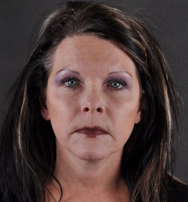 facelift - patient 8850 - after 1 facelift - patient 8850 - after 1