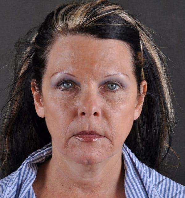 facelift - patient 8850 - before 1 facelift - patient 8850 - before 1