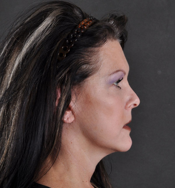 facelift - patient 8850 - after 3 facelift - patient 8850 - after 3