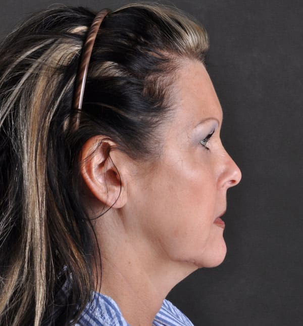 facelift - patient 8850 - before 3 facelift - patient 8850 - before 3